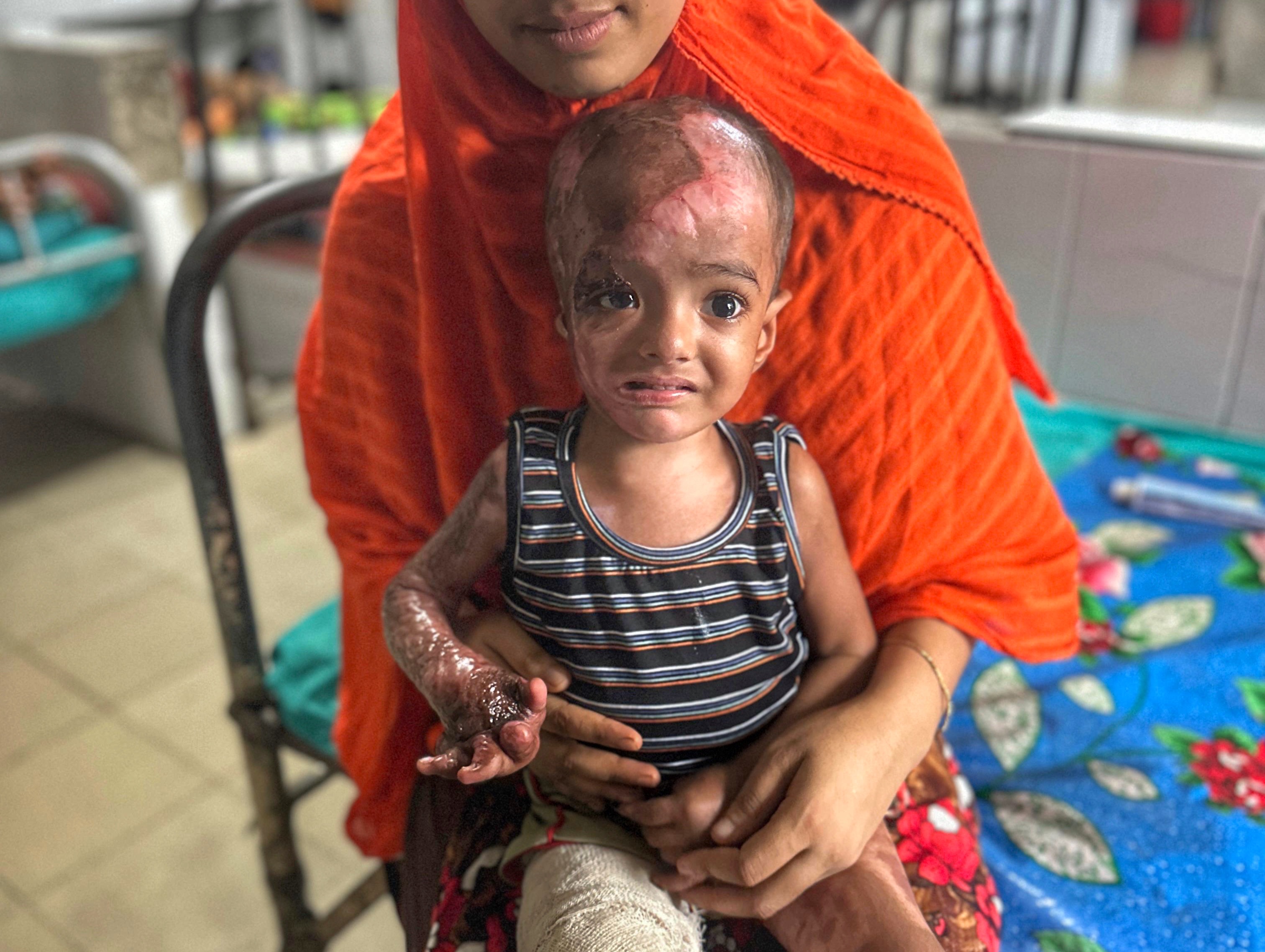 Fire Survivor Who Fought Death and Won.